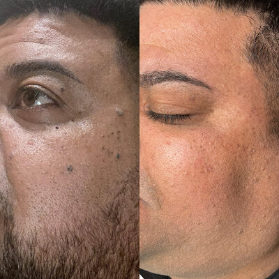 Skin Tag Remover