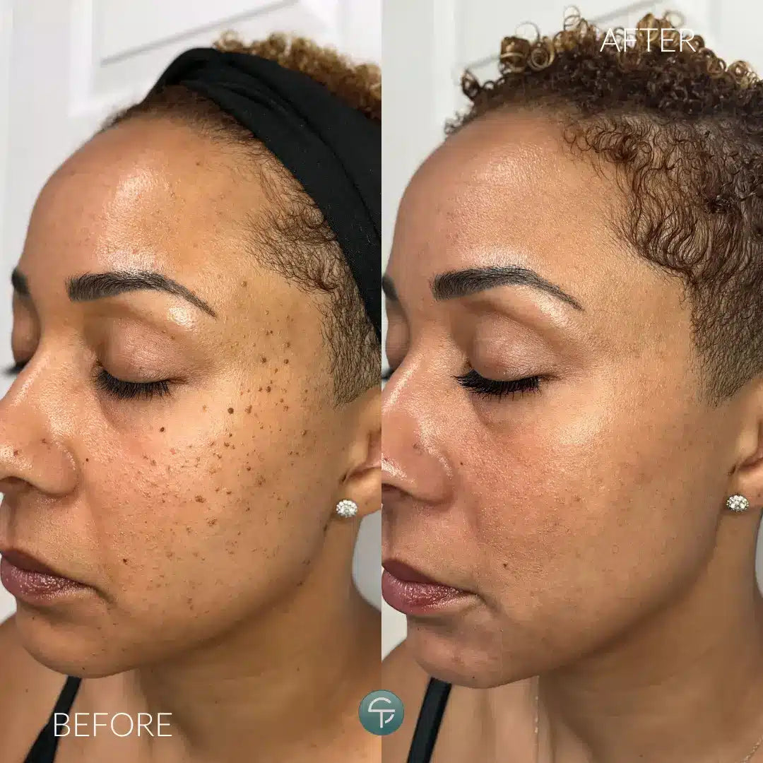 Skin Tag Remover
