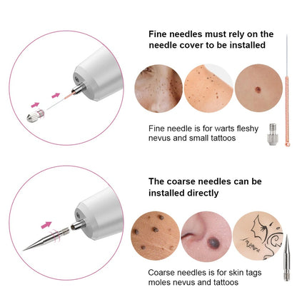 Skin Tag Remover
