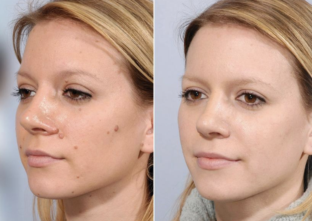 Skin Tag Remover