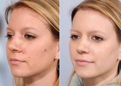 Skin Tag Remover